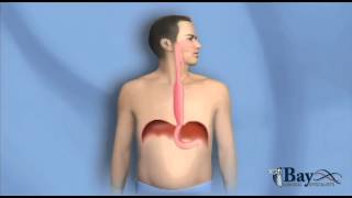 Esophagectomy the Esophagus Removal Surgery [upl. by Rance]