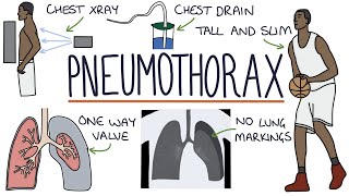 Hemothorax pneumothorax pleural effusion [upl. by Lebiralc532]