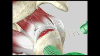 Arthroscopic Rotator Cuff Repair [upl. by Talya723]