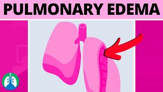 Pulmonary Edema Medical Definition  Quick Explainer Video [upl. by Secundas840]