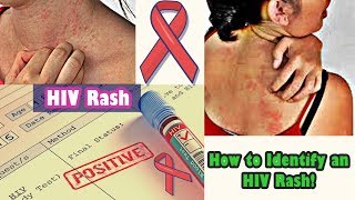 How to Identify an HIV Rash [upl. by Nnaul822]