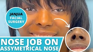 NOSE JOB ON ASSYMETRICAL NOSTRILS POSTOP RESULTS  DR TANVEER JANJUA  NEW JERSEY [upl. by Juni572]