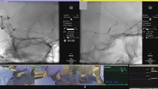 Stentassisted coil embolization of MCA aneurysm via a transposterior communicating artery access [upl. by Samul]