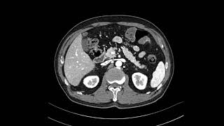 GB adenomyomatosis [upl. by Hgielhsa]