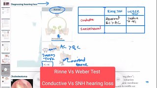 Conductive vs sensorineural hearing loss neurology 159 First Aid USMLE Step 1 in UrduHindi [upl. by Winer28]