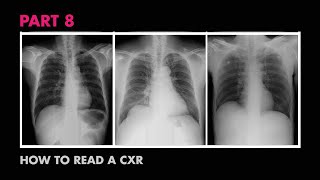 Diaphragms and Pleural Effusion  How to Read a Chest XRay Part 8  MEDZCOOL [upl. by Naloc339]