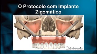 Protocolo Zigomático [upl. by Connett]