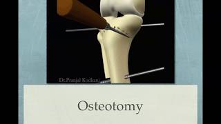 Dome osteotomy for knee osteoarthrosis [upl. by Leelaj983]