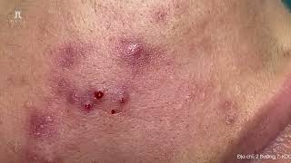 Big Cystic Acne Blackheads Extraction Blackheads amp Milia Whiteheads Removal Pimple Popping [upl. by Leonidas]