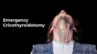 Performing an Emergent Cricothyroidotomy  MEDZCOOL [upl. by Eimmak612]