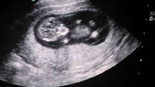 Babys First Ultrasound 11 weeks 1 day [upl. by Harod]