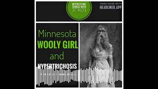 573 quotThe Minnesota Woolly Girl and Hypertrichosisquot [upl. by Esylla]