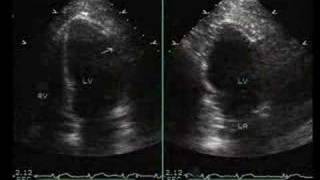 InferiorPosterior and Lateral Myocardial Infarction [upl. by Kitrak]