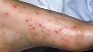 How to Treat Pinpoint Petechiae [upl. by Dawaj]