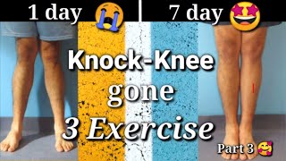 Knock Knee Correction with EXERCISE in 7 days [upl. by Shifra]