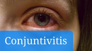 Conjuntivitis vírica alérgica y bacteriana síntomas y tratamiento [upl. by Ivy]