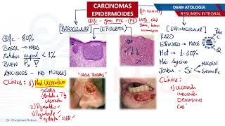 Dermatología  Carcinoma epidermoide [upl. by Tiat261]