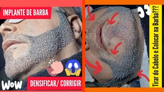 TRANSPLANTE DE BARBA  FIOS BRANCOS padraocmc ♨️ [upl. by Neve748]