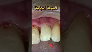 تخفيضات في الزركون promotion Zircone agadir dentist agadirmorocco smile explore [upl. by Nisa822]