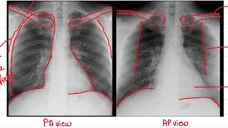 BASICS OF CHEST XRAY PART1AP VS PA VIEWXRAY MADE EASYRADIOLOGY [upl. by Ardnuat]