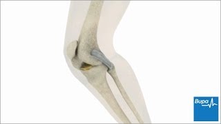 How knee arthroscopy is carried out  Bupa Health [upl. by Nnednarb]