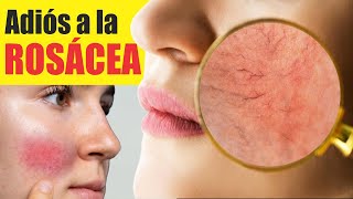 Tratamiento para la ROSÁCEA 🥵 Enrojecimiento y piel caliente 😡 TELAGECTASIAS en CARA 💋Dermatología [upl. by Dnalyag672]