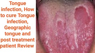 Geographic tongue Tongue infection Mouth inside infection benign migratory glossitis causes amp Tt [upl. by Jillene596]