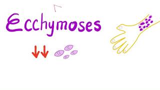 Ecchymoses  Low Platelet Count [upl. by Adniled260]