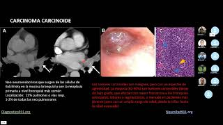 Neoplasias Traqueobronquiales Benignas y Malignas [upl. by Zerelda]