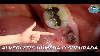 TRATAMIENTO PARA ALVEOLITIS HUMEDA Y ALVEOLITIS SECA [upl. by Alyl]