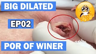 Blackheads Two Big Dilated Pores of Winer EP02 [upl. by Acemaj]