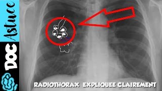 🔴 5 Dr Astuce  APPRENDS LE SYNDROME ALVEOLAIRE EN  DE 5 MIN  partie 1  Dr Astuce [upl. by Dal]