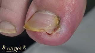 😱GRANULOMA SUBUNGUEAL COM FINAL INCRÍVEL nails satisfying [upl. by Davilman]