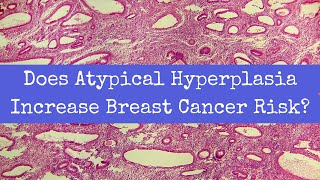 Does Atypical Hyperplasia Increase Breast Cancer Risk [upl. by Ecinehs]