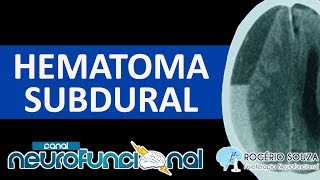 HEMATOMA SUBDURAL Vídeo Aula  TCE 3 [upl. by Solita]