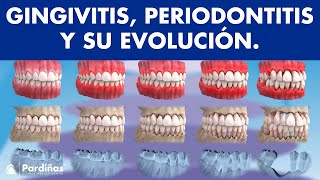 Gingivitis y periodontitis  Avance y evolución  Encías sangrantes © [upl. by Jansen]