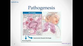 Bronchiolitis 8 31 24 [upl. by Alica]