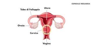 Conizzazione cervicale [upl. by Ttreve]