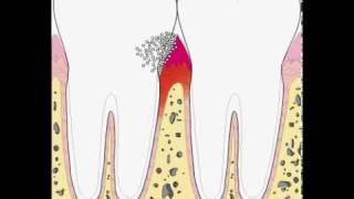 Enfermedad Periodontal  Periodontitis [upl. by Rma]