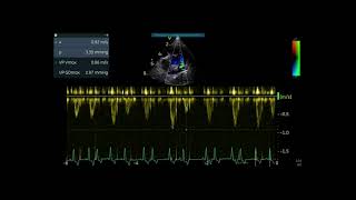 Echocardiographic of inflow velocity patterns during supraventricular extrasystoles in dog🐕 [upl. by Augusto]