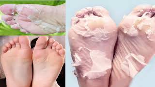 How to Get Rid of Peeling Skin on Your Feet [upl. by Kinata]