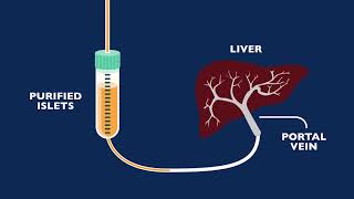 Auto Islet Transplant Program [upl. by Odelet]