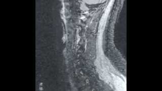 Cspine MRI withwithout contrast [upl. by Silvestro]