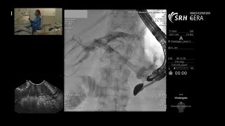 EUSgeführte HepaticoGastrostomie Teil 12 [upl. by Nagard815]