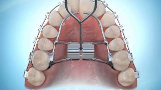 Hyrax Rapid Palatal Expansion Braces During [upl. by Nets]