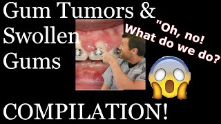 Braces causing gum tumorsswollen gums compilation [upl. by Gnuj225]