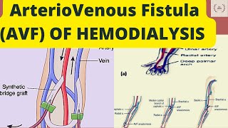 Arteriovenous fistulaAVFManagement of fistulaAnastomosisAneurysm Types of fistulaNeedles size [upl. by Assenal785]