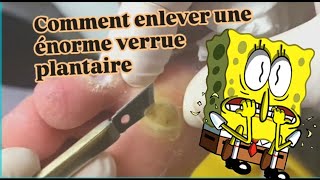 Comment enlever une énorme verrue plantaire [upl. by Brnaby]