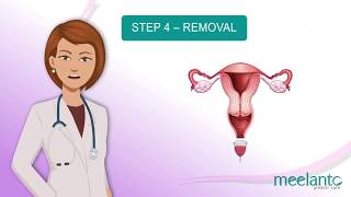 How to use menstrual cup  indepth explanation video [upl. by Hamlin]