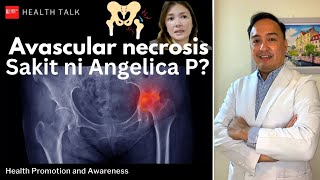 Avascular necrosis Sakit ni Angelica P Ano ito Causes risks symptoms and treatment [upl. by Brandice514]